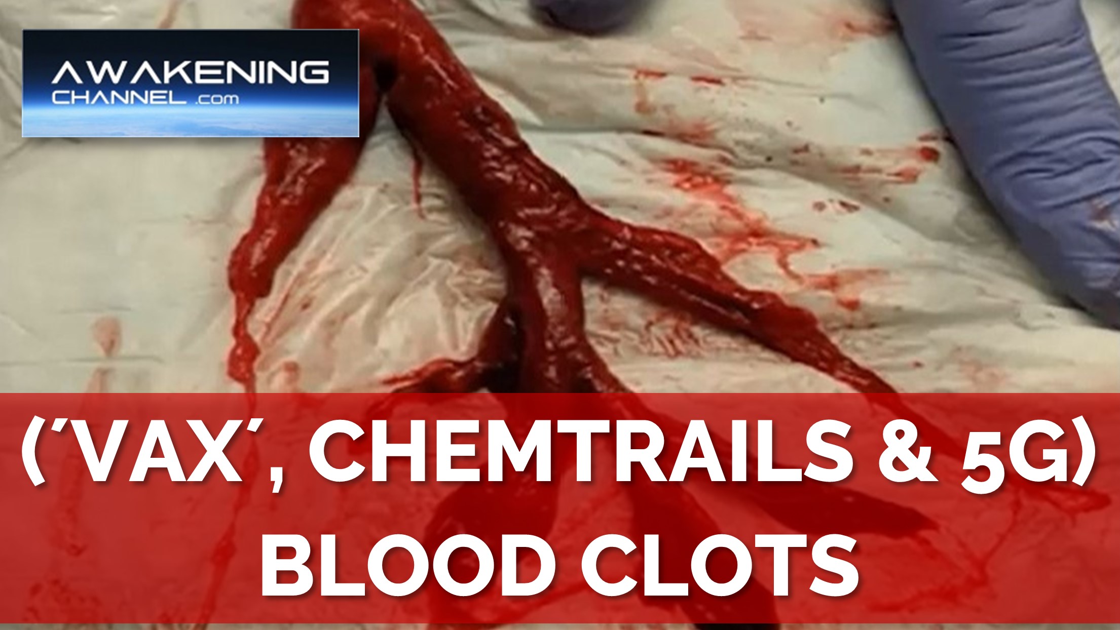 (´VAX´, CHEMTRAILS & 5G) BLOOD CLOTS